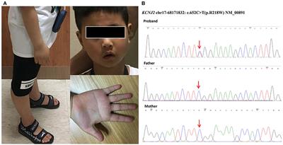 Case report: Mexiletine suppresses ventricular arrhythmias in Andersen-Tawil syndrome